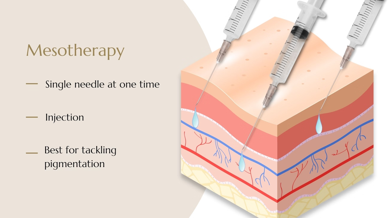 mesotherapy-clinic-london_hbfff.avif